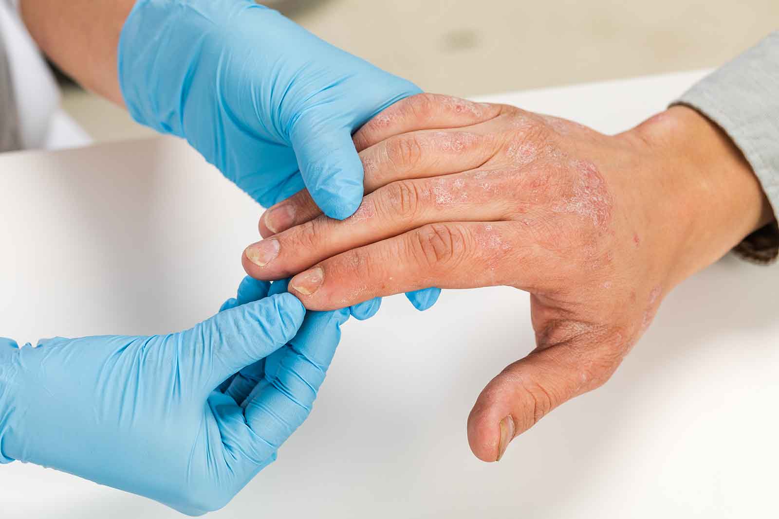 Razumijevanje i liječenje psorijaze