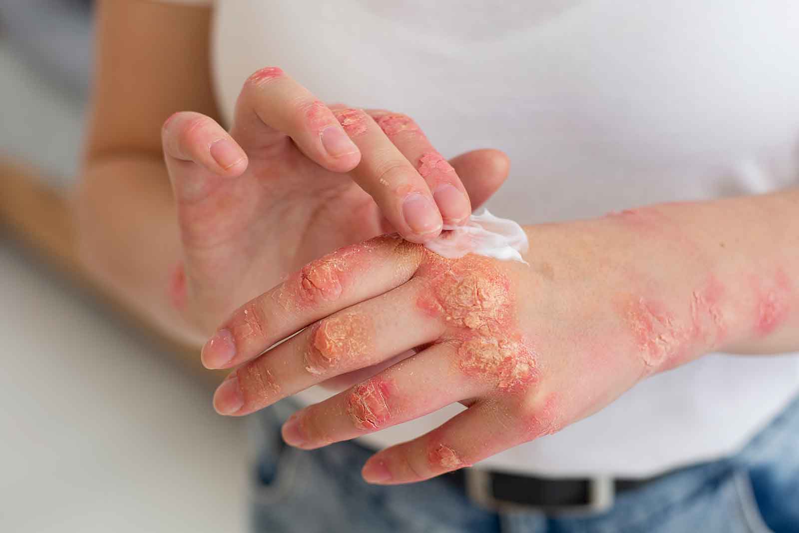 Razumijevanje i liječenje psorijaze